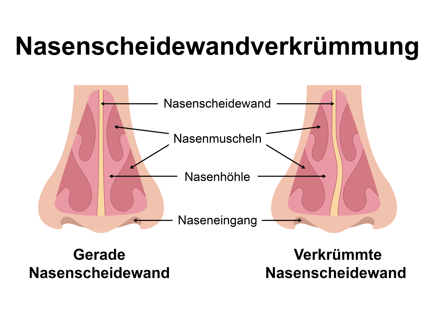 schaubild-nasenscheidewandverkruemmung Schaubild einer Nasenscheidewandverkrümmung